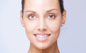 Fractional laser CO2