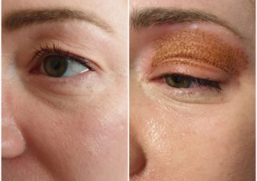 ANAIΜΑΚΤΗ ΒΛΕΦΑΡΟΠΛΑΣΤΙΚΗ με PLEXR