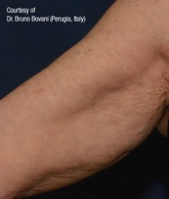 After-Inner-Arm-Dr-Bovani-gallery--240x283