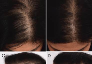 Θεραπεία Τριχόπτωσης PRP